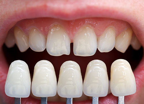 dental veneer maintenance