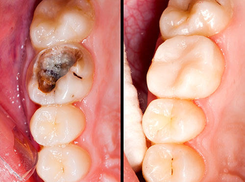 discolored fillings