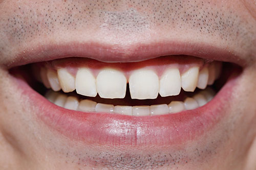 space between front teeth