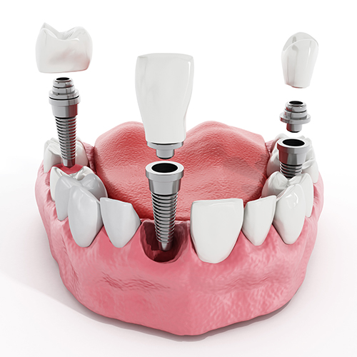 Benefits of Dental implants